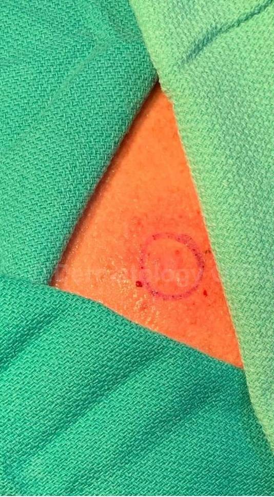 Skin Cancer (Excision) Case-104 Before