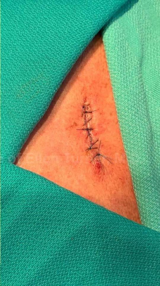 Skin Cancer (Excision) Case-104 After