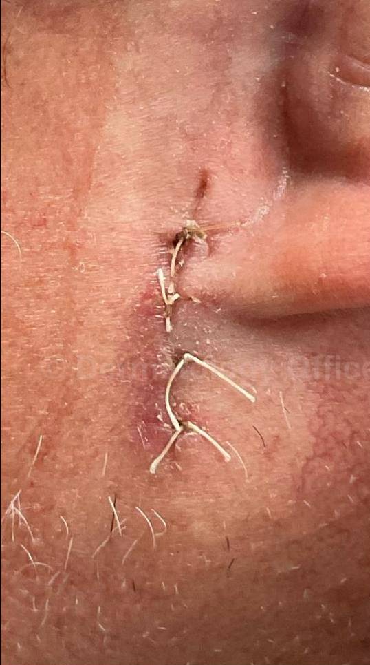 Skin Cancer (Sutures Removal) Case-103 Before