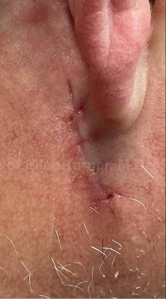 Skin Cancer (Sutures Removal) Case-103 After
