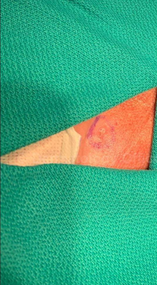 Skin Cancer (Excision) Case-102 Before