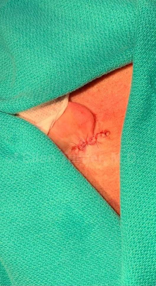 Skin Cancer (Excision) Case-102 After