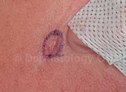 Skin Cancer (Excision) Case-99 Before