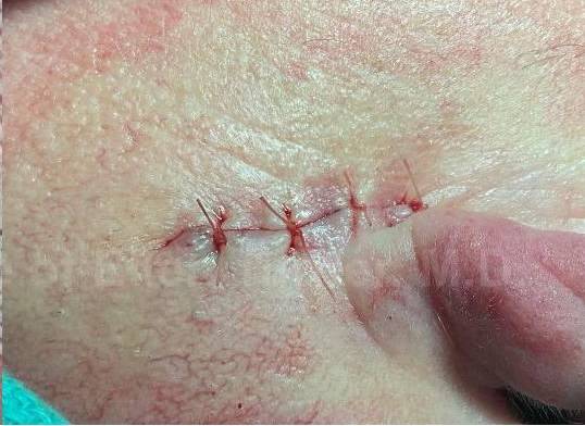 Skin Cancer (Excision) Case-99 After