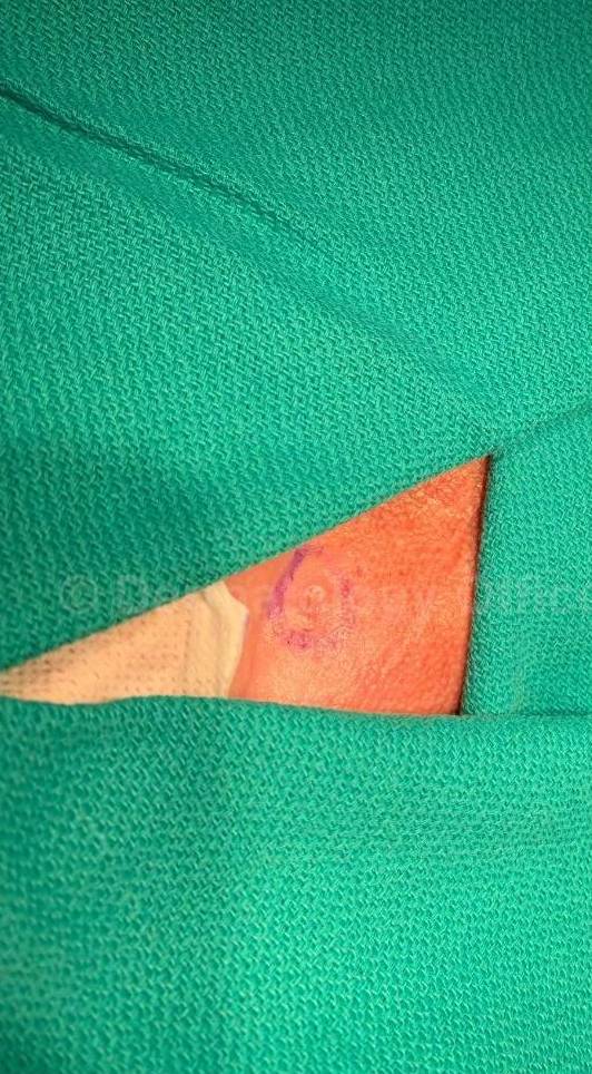 Skin Cancer (Excision) Case-98 Before