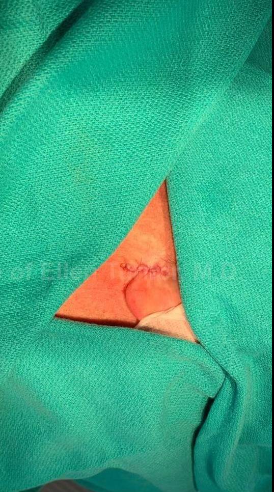 Skin Cancer (Excision) Case-98 After