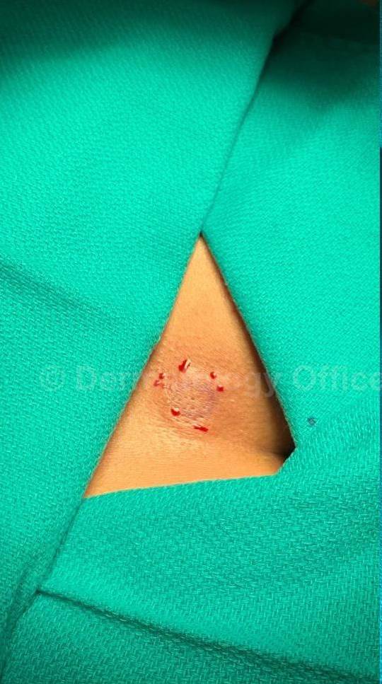 Skin Cancer (Excision) Case-97 Before