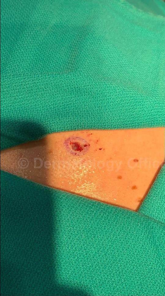 Skin Cancer (Excision) Case-96 Before