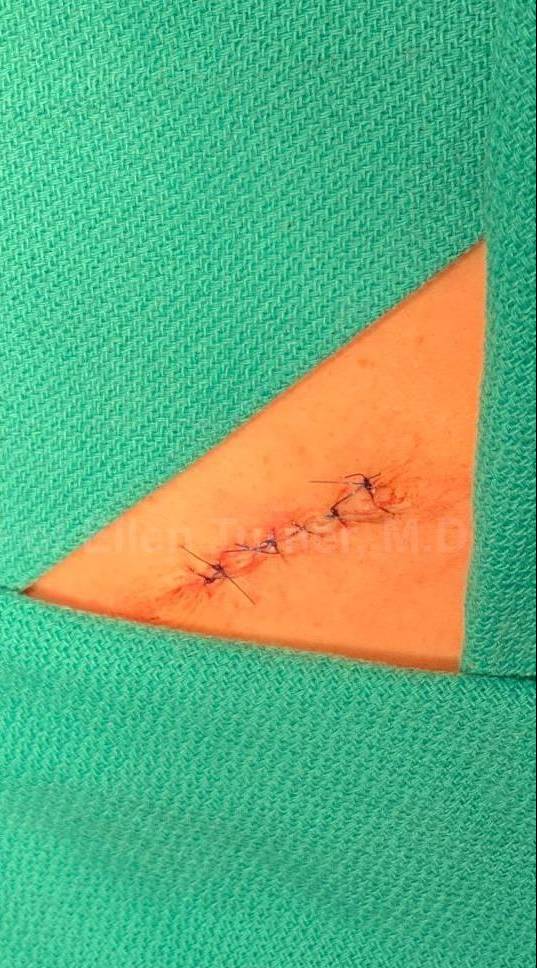 Skin Cancer (Excision) Case-96 After