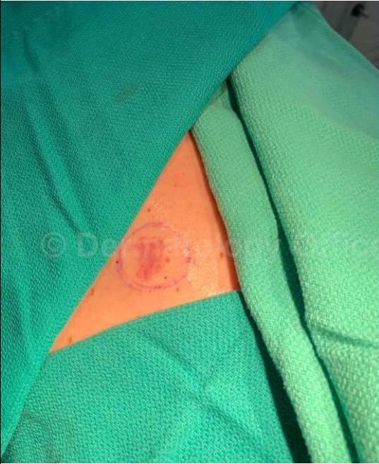 Skin Cancer (Excision) Case-95 Before