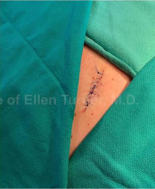 Skin Cancer (Excision) Case-95 After
