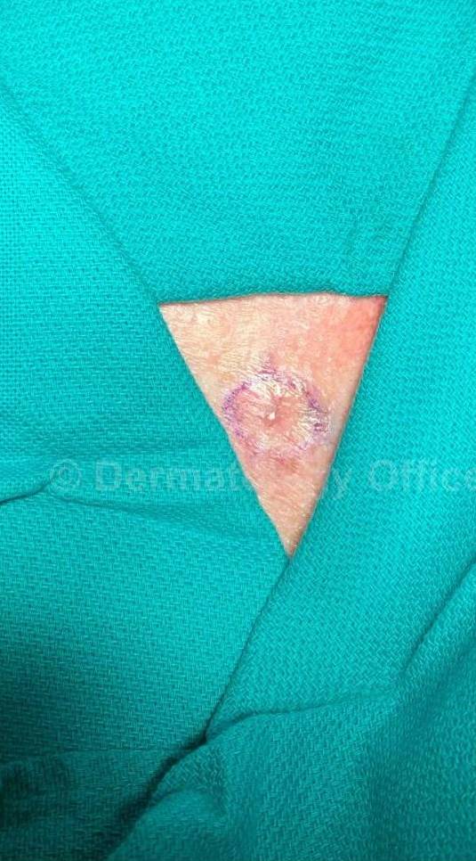Skin Cancer (Excision) Case-100 Before
