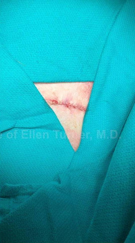 Skin Cancer (Excision) Case-100 After