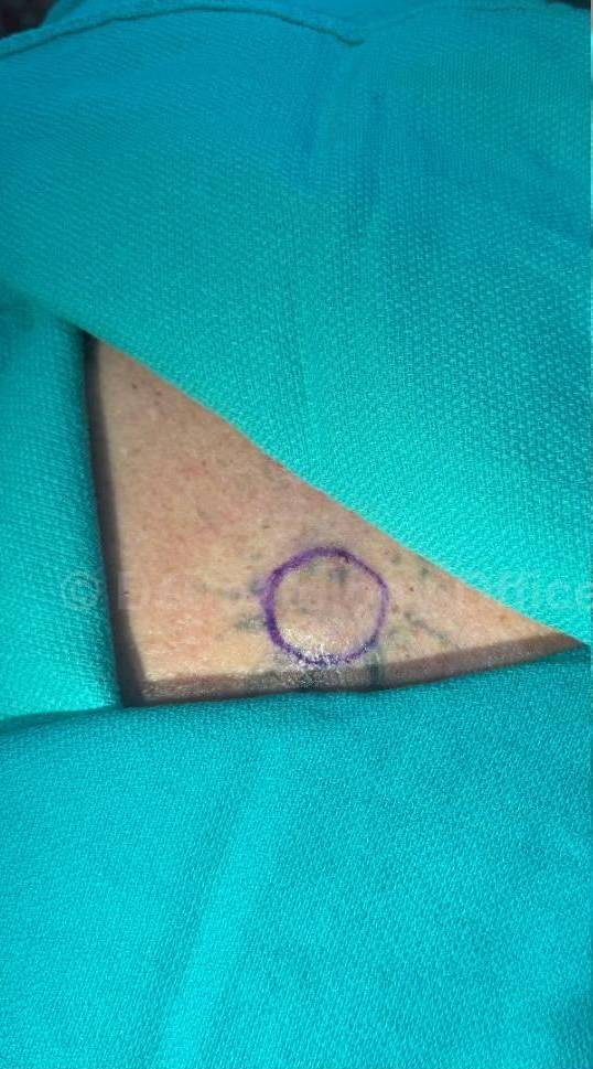 Skin Cancer (Excision) Case-101 Before