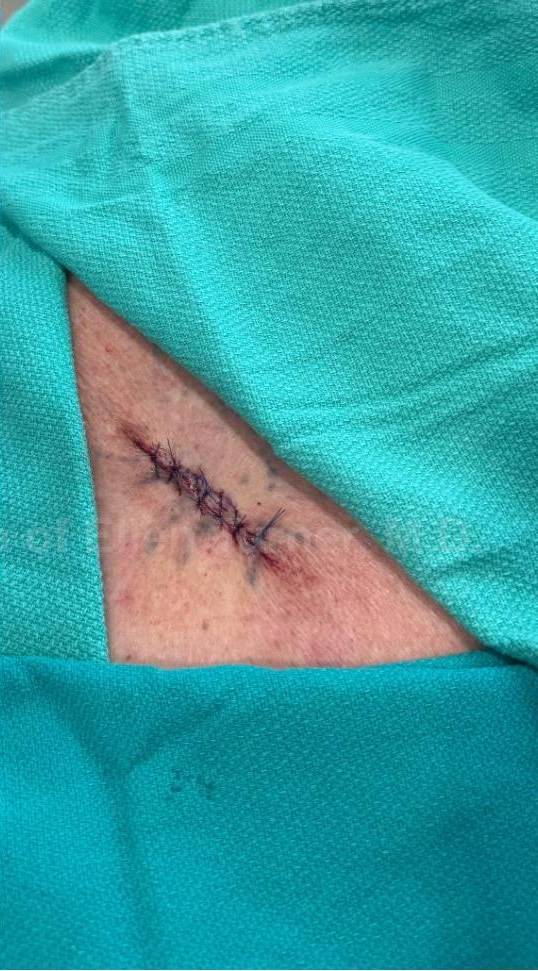 Skin Cancer (Excision) Case-101 After