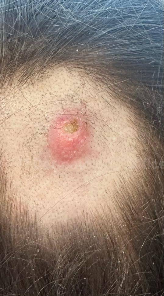 Skin Cancer (Excision) Case-94 Before