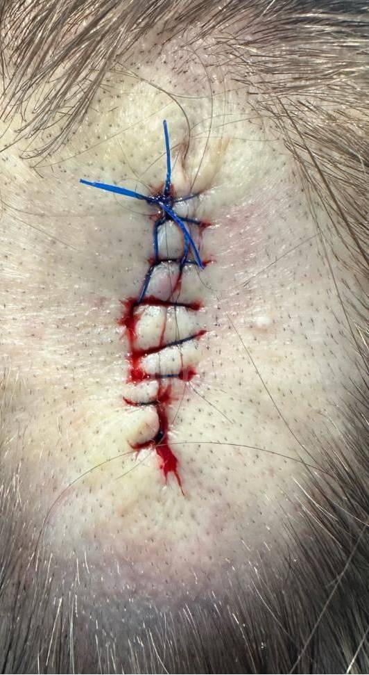 Skin Cancer (Excision) Case-94 After