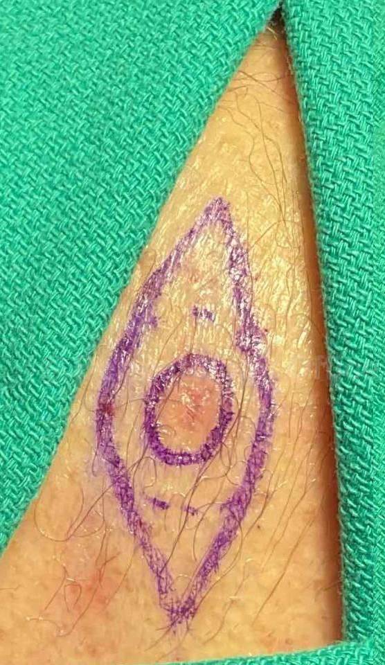 Before and After Skin Cancer (Excision) Case-84 Before