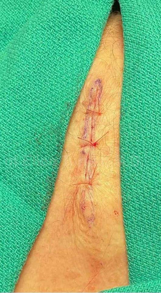 Before and After Skin Cancer (Excision) Case-84 After