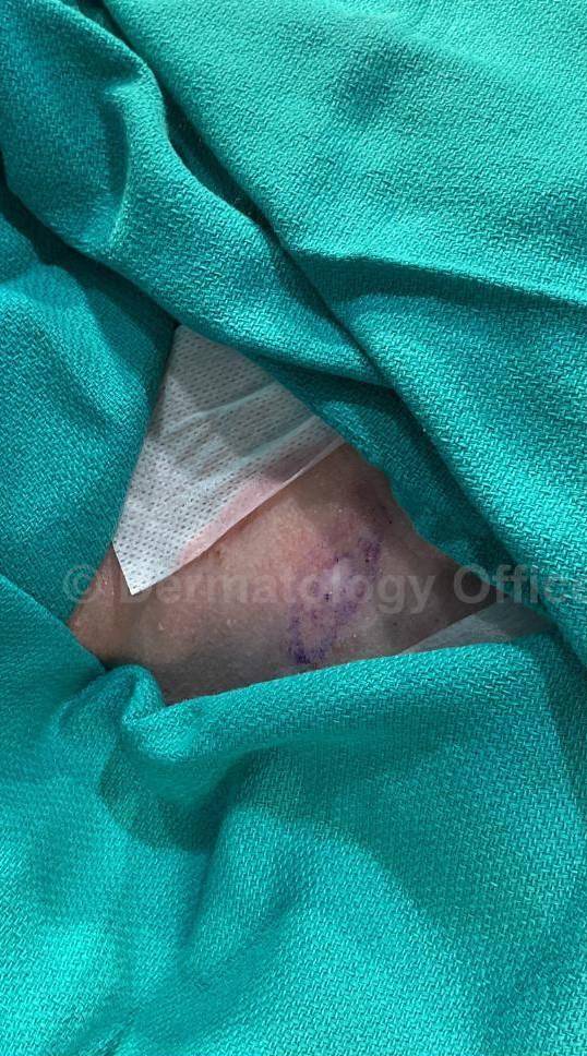 Skin Cancer (Excision) Case-86 Before