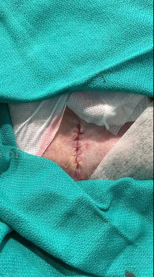 Skin Cancer (Excision) Case-86 After