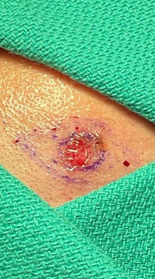 Skin Cancer (Excision) Case-87 Before