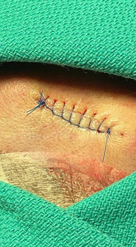 Skin Cancer (Excision) Case-87 After