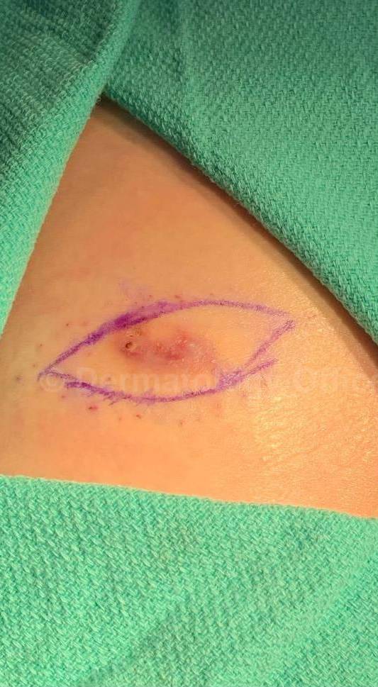 Skin Cancer (Excision) Case-88 Before