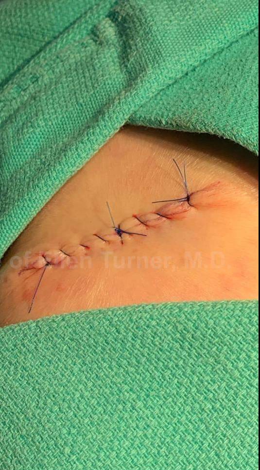 Skin Cancer (Excision) Case-88 After