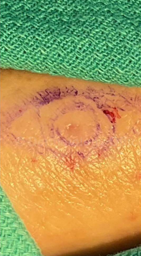 Skin Cancer (Excision) Case-89 Before