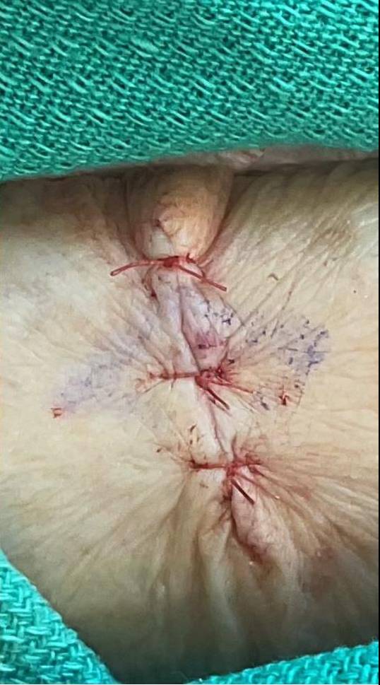 Skin Cancer (Excision) Case-89 After