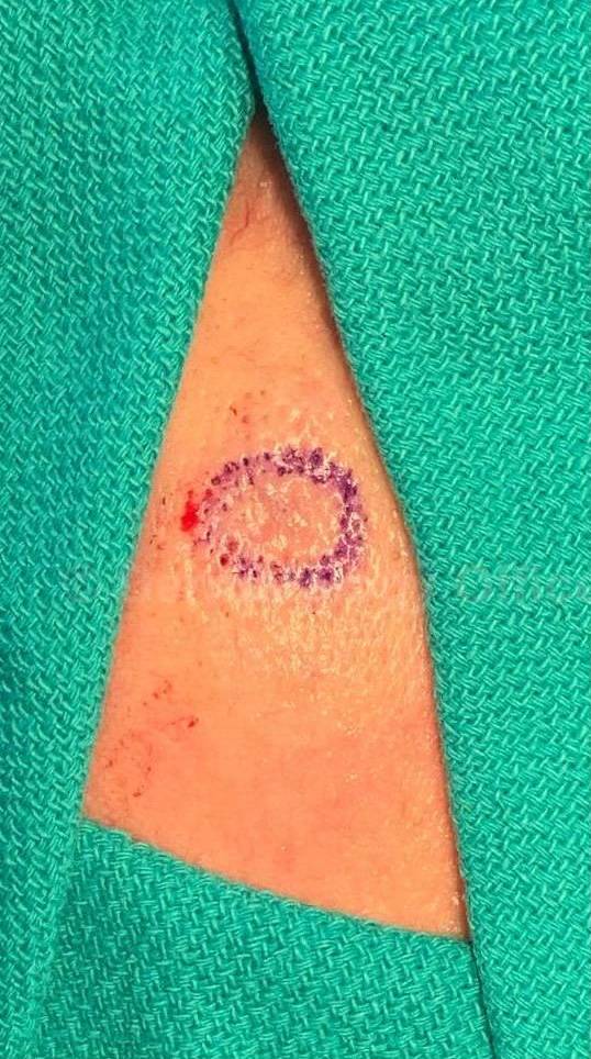 Skin Cancer (Excision) Case-90 Before