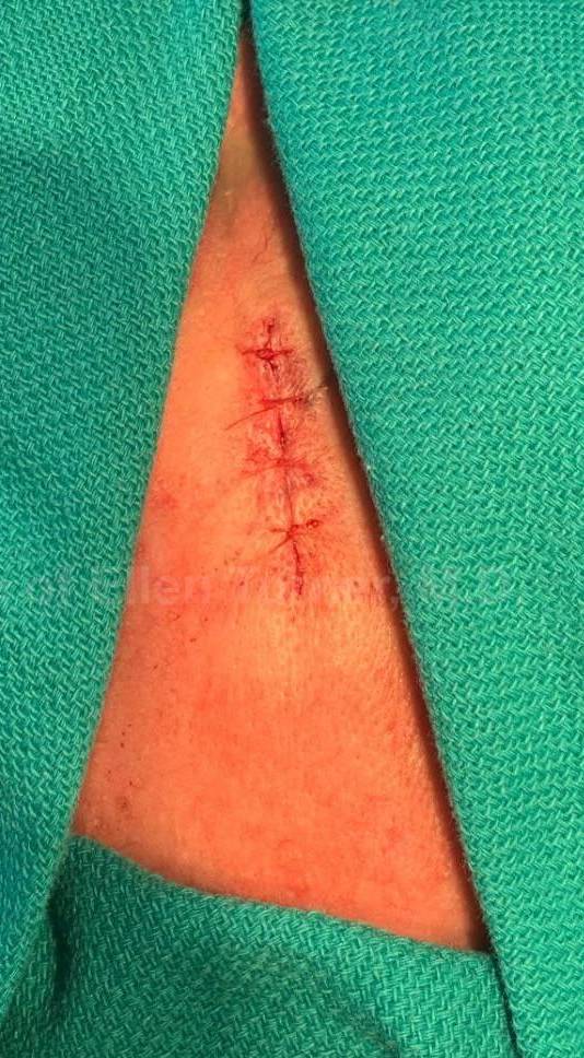 Skin Cancer (Excision) Case-90 After