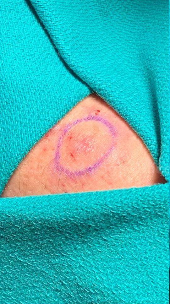 Skin Cancer (Excision) Case-91 Before