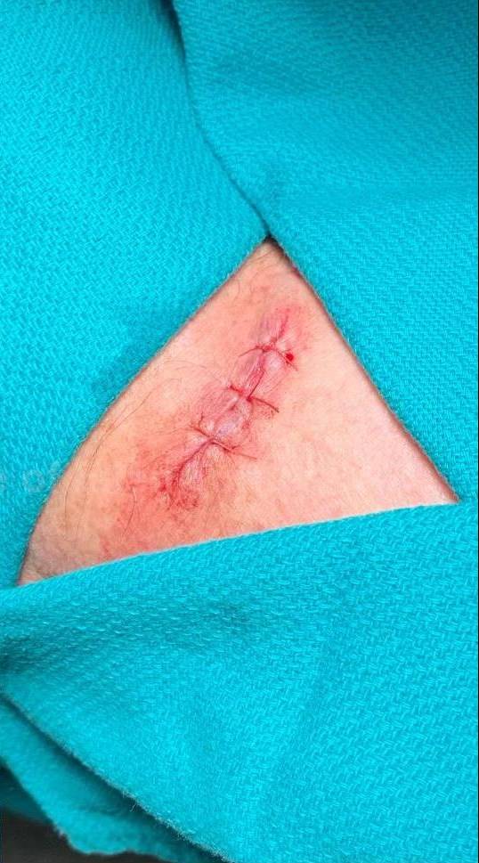 Skin Cancer (Excision) Case-91 After