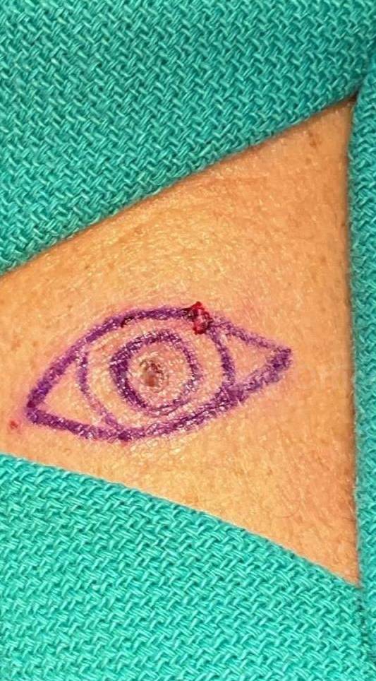 Skin Cancer (Excision) Case-92 Before