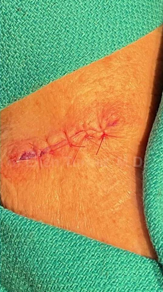 Skin Cancer (Excision) Case-92 After