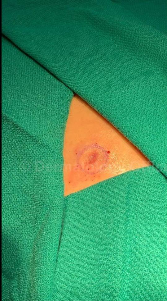 Skin Cancer (Excision) Case-93 Before