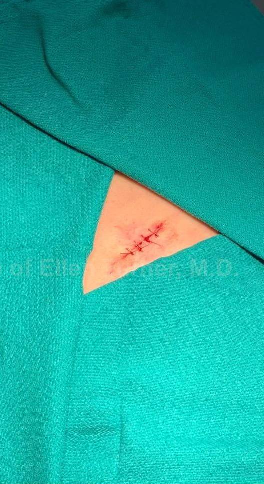 Skin Cancer (Excision) Case-93 After