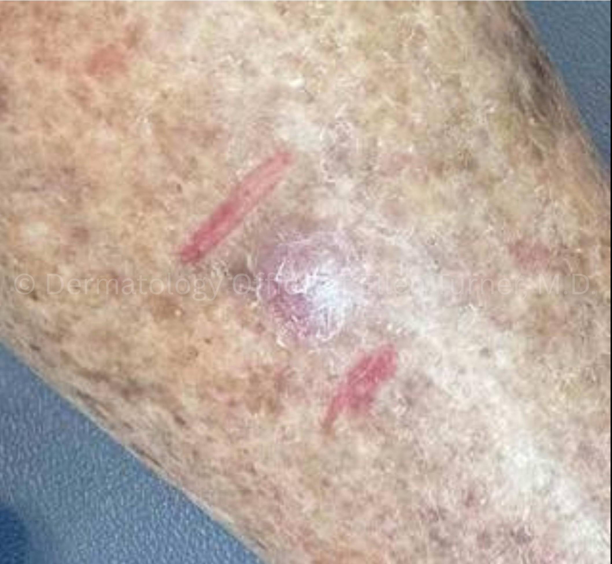 SRT-100 Before and After Case-97 Before