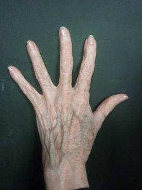 Radiesse Hands (3 Syringes) Before and After Case 7 Before