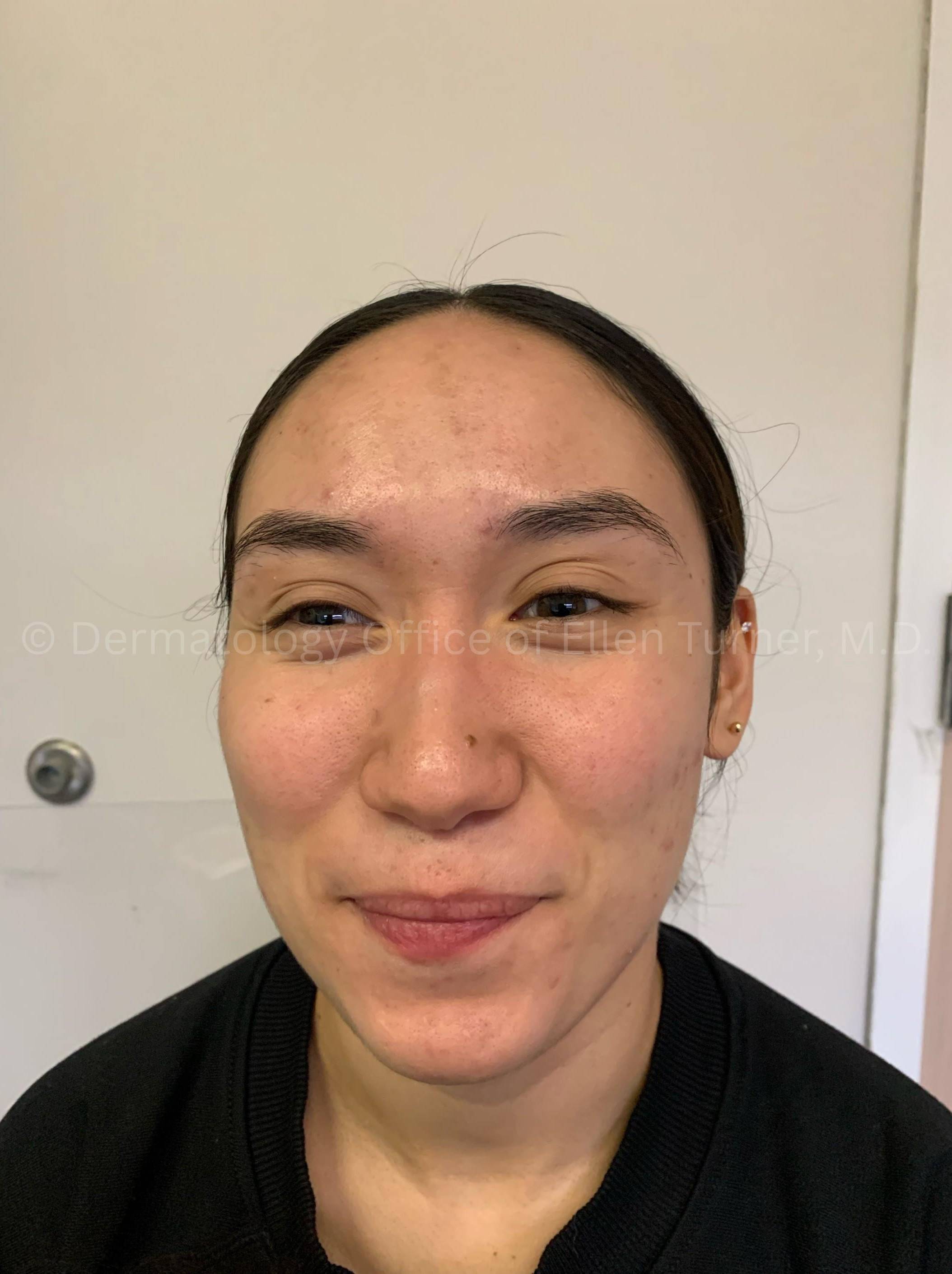 Acne Before and After Case -29 Before