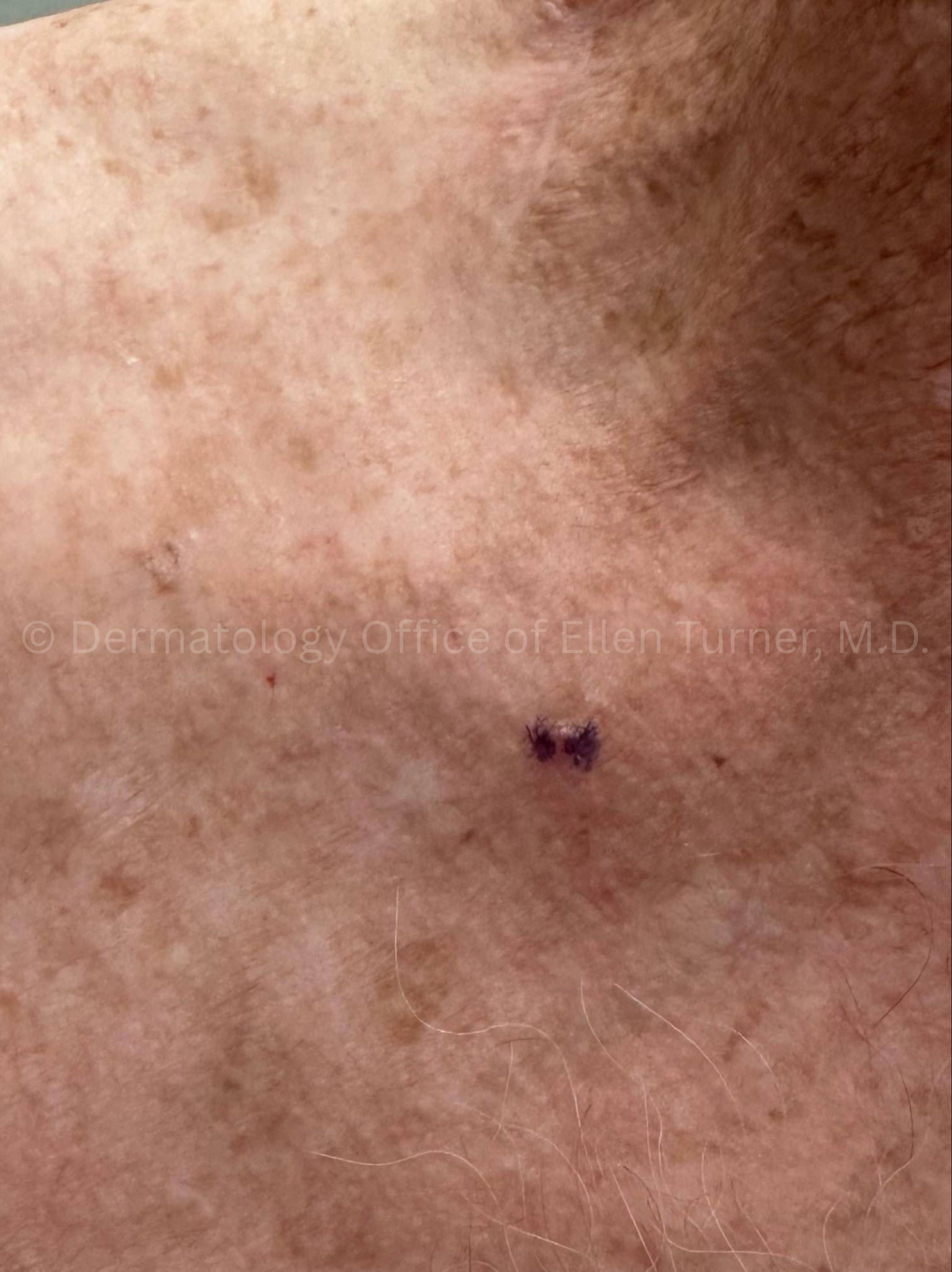 SRT-100 Before and After Case-98 Before