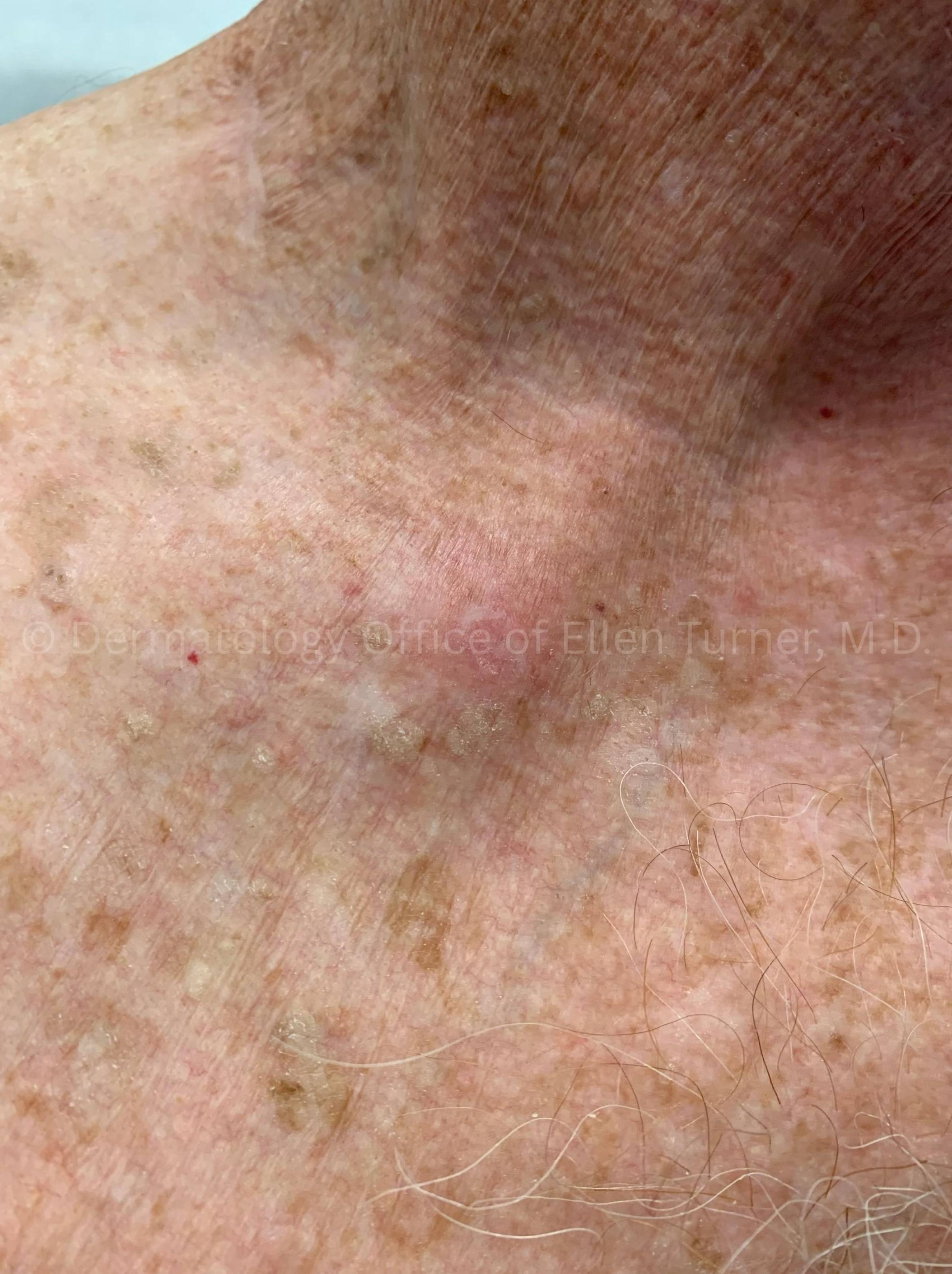 SRT-100 Before and After Case-98 After