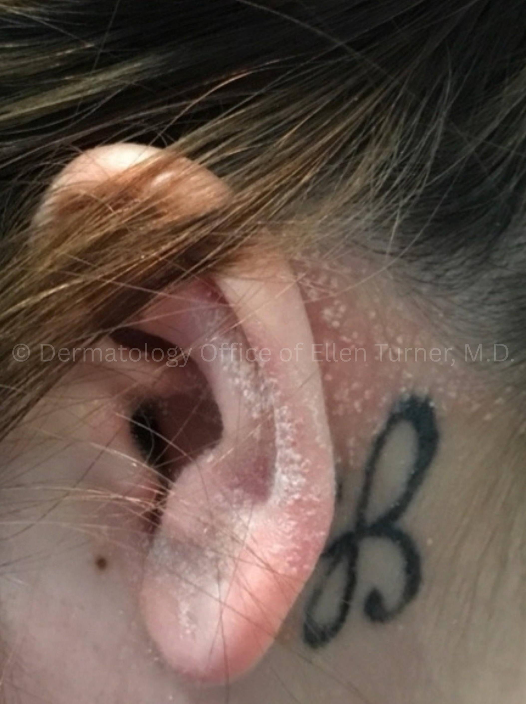 Psoriasis Before and After Case-62 Before