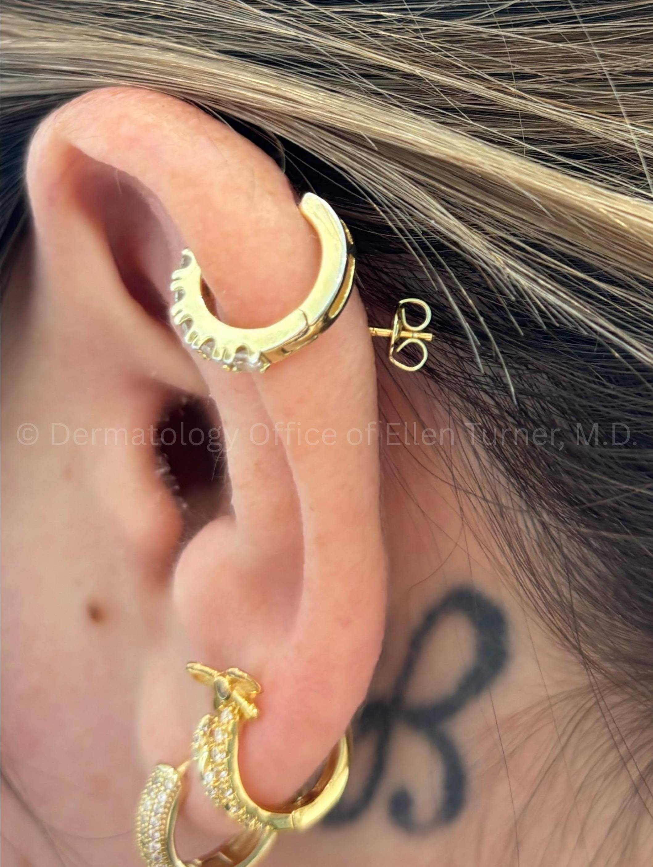 Psoriasis Before and After Case-62 After