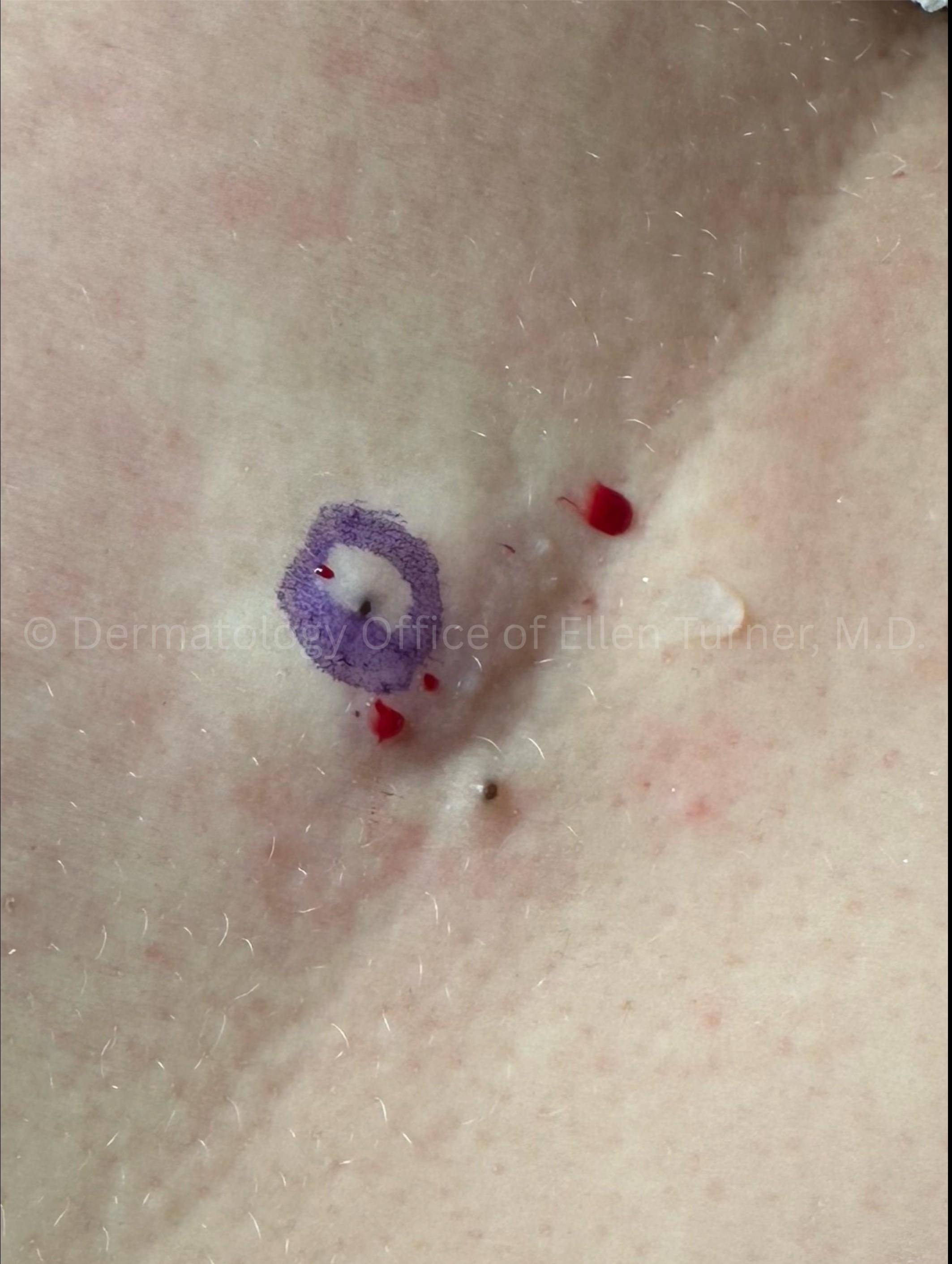 Cyst Removal Before and After Case-58 Before