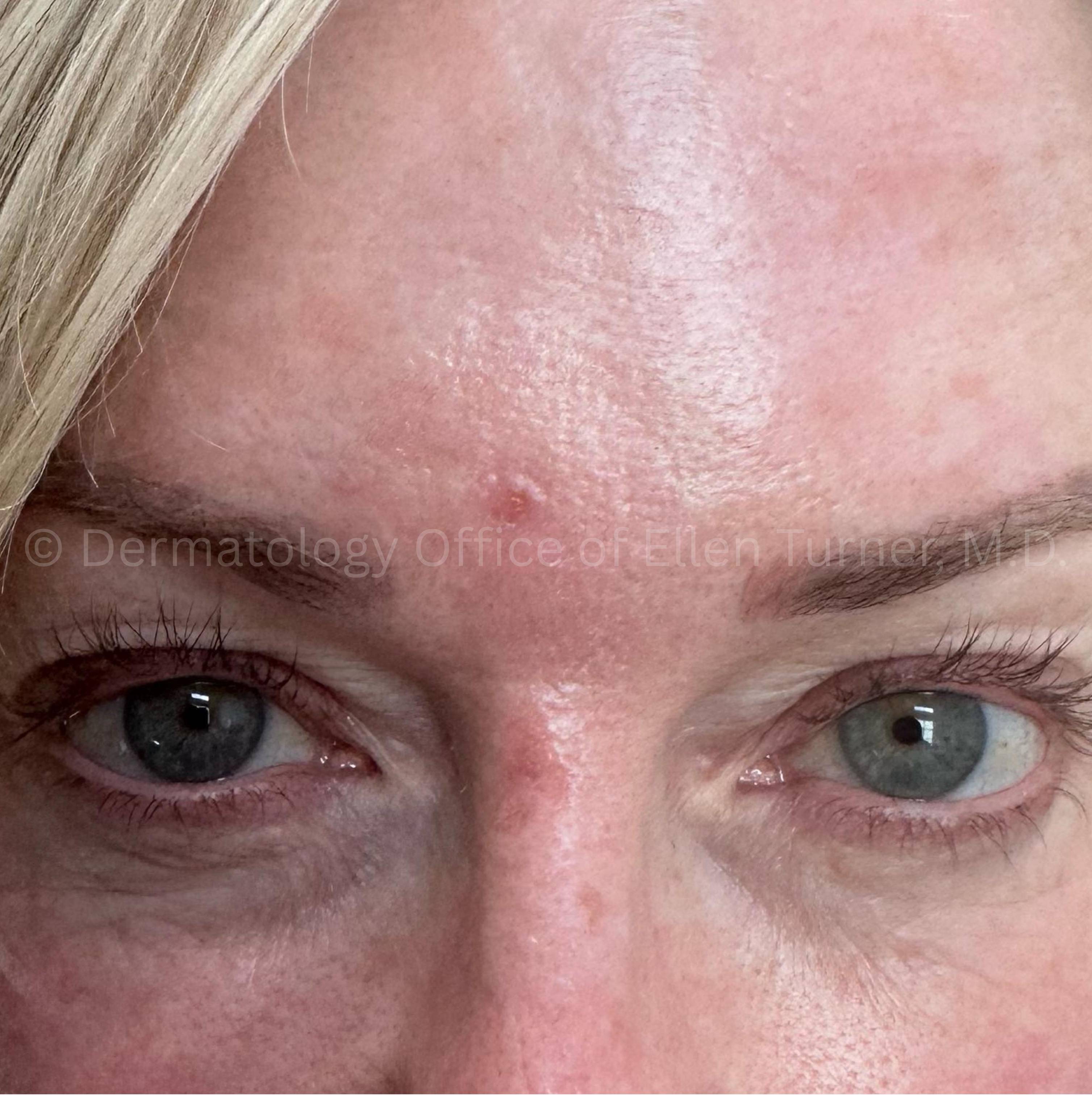 SRT-100 Before and After Case-100 After