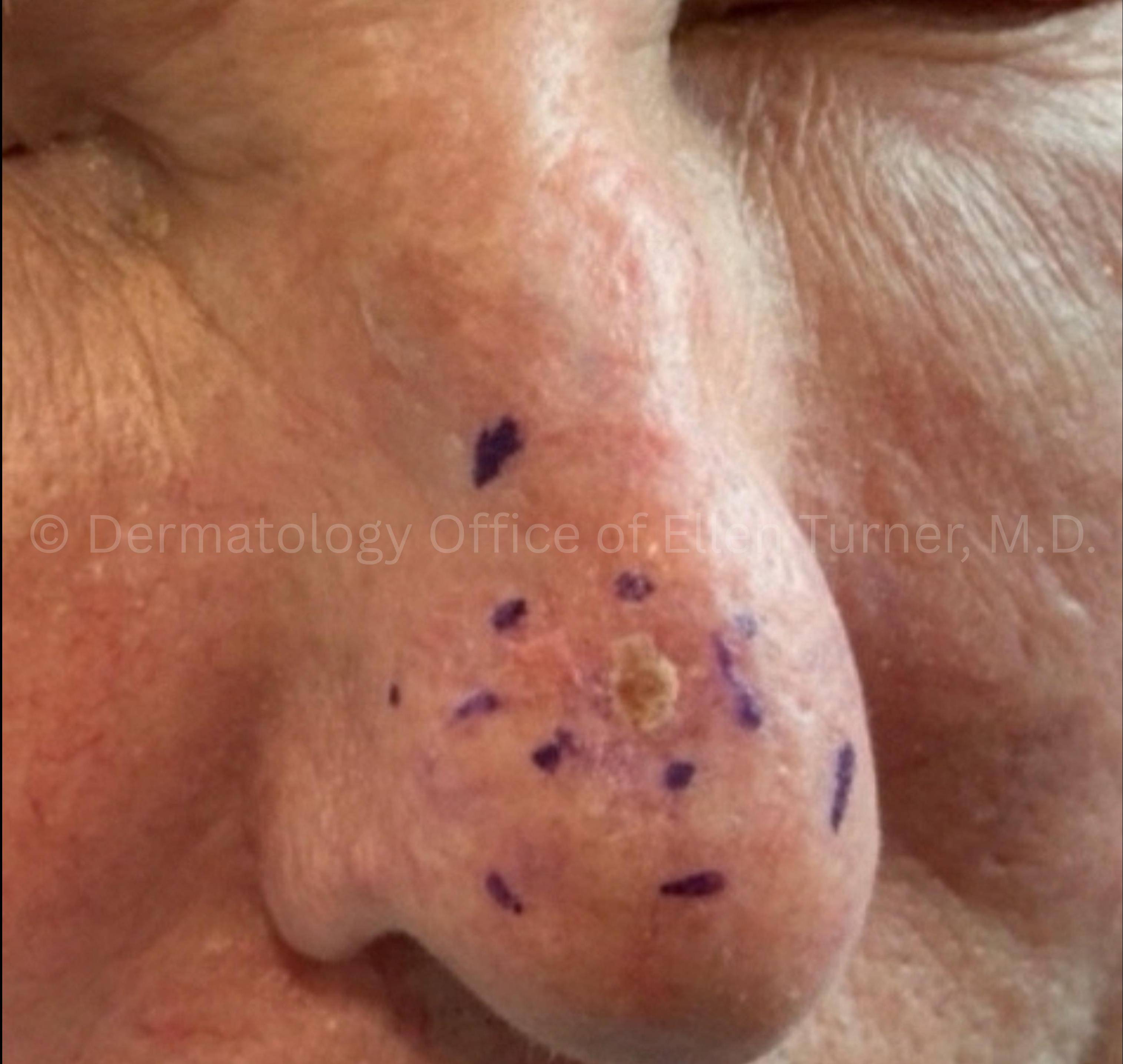 SRT-100 Before and After Case-101 Before