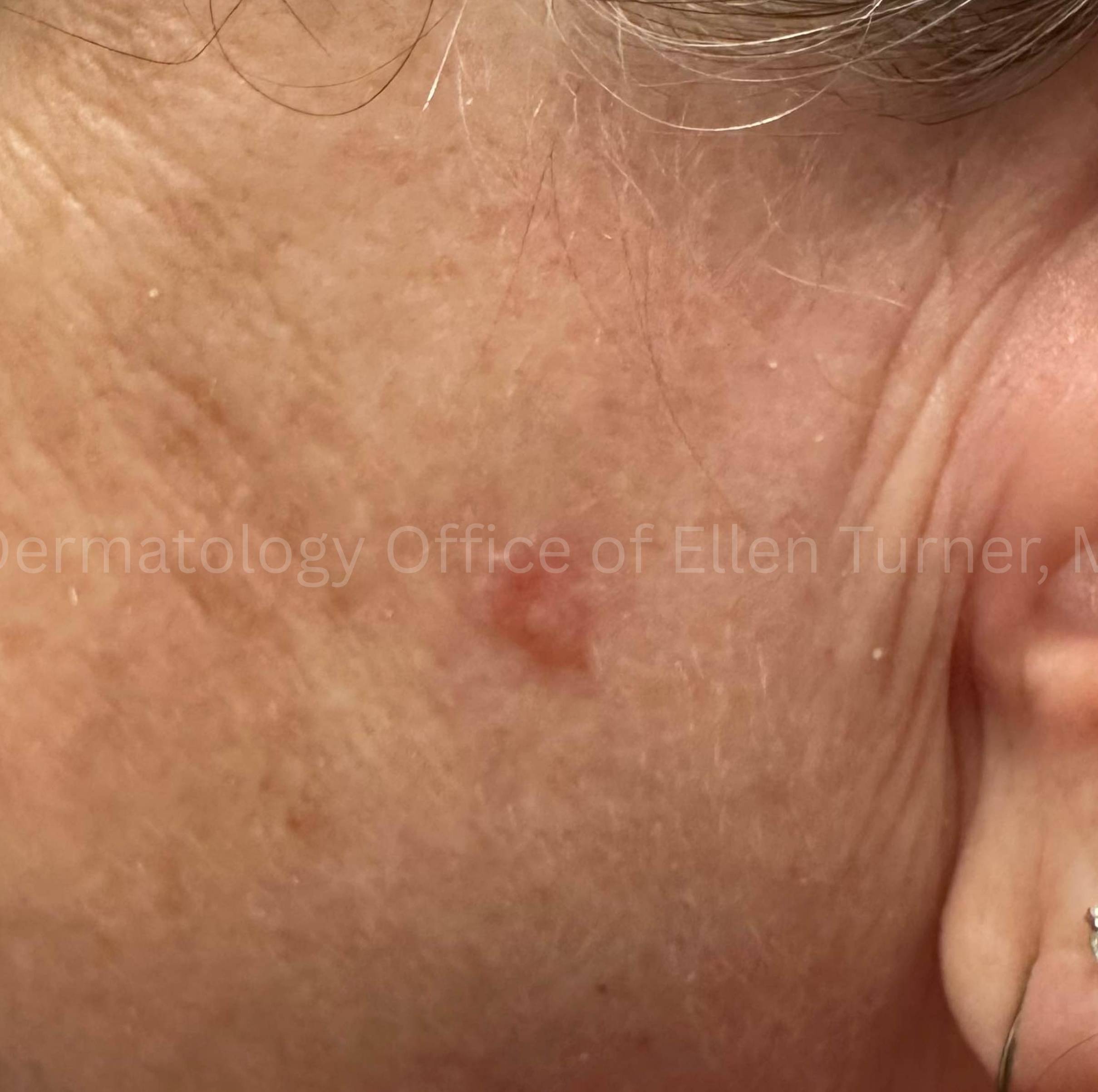 SRT-100 Before and After Case-102 Before